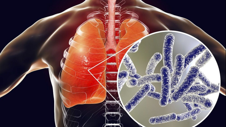 1656411682 legionela