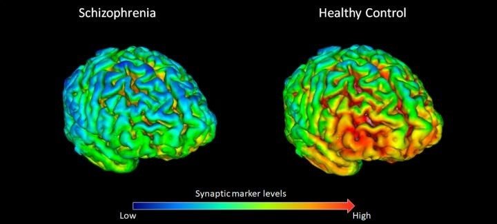 18 Voluntarios Sanos (Derecha) Tienen, En Promedio, Niveles Más Altos (Mostrados En Amarillo-Rojo) De La Proteína Marcadora De La Sinapsis SV2A Que 18 Participantes Con Esquizofrenia (Izquierda). | MRC LONDON INSTITUTE OF MEDICAL SCIENCES ep 18 voluntarios sanos derecha tienen en promedio niveles mas altos mostrados en amarillo-rojo de