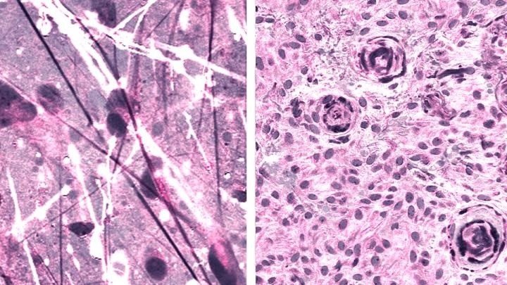 ep imagenes histologicas raman estimuladas de astrocitoma difuso izquierda y meningioma derecha