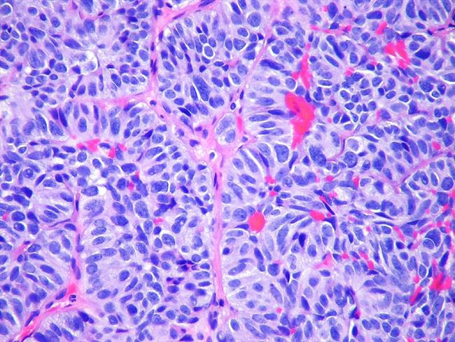 ep metastasis pulmon