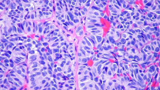 ep metastasis pulmon