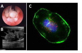 ep investigadores de estados unidos evidencian que el antrax puede ser eficaz para tratar el cancer